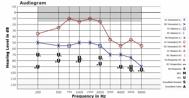 Hyperacusis management chart